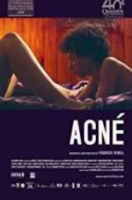 Acné